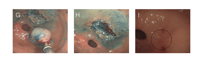 G. 올가미로 절제한 후 파악겸자로 회수하는 모습.
H. 절제한 후 절제술에 의해 생긴 궤양에서 부분적으로 소량의 출혈이 보인다.
I. 3개월 추적 내시경 사진으로 궤양이 반흔으로 치유된 모습.