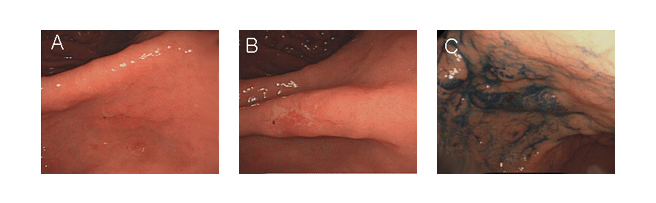 A, 위각 바로 아래 소만부에 발생한 얕은 궤양 모양이 보인다.
B, A를 확대한 사진으로 궤양이 잘 보인다.
C, Indigocarmine 색소를 뿌려 울퉁불퉁한 표면과 병변의 경계가 좀 더 잘 보인다.