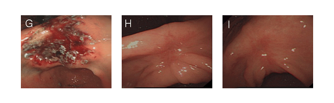 G. 절제한 후 절제술에 의해 생긴 궤양에서 부분적으로 소량의 출혈이 보인다.
H. 2개월 추적 내시경 사진으로 궤양이 반흔으로 치유된 모습.
I. 8개월 추적 내시경 사진으로 궤양 반흔이 좀 더 부드럽게 보인다.