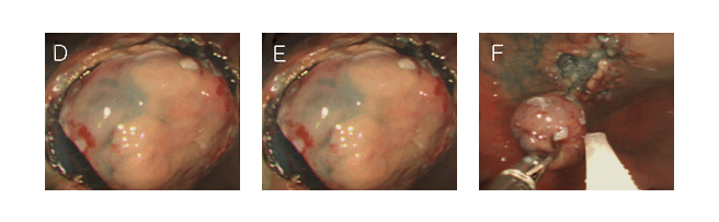 D, E. 절개도의 끝에 절연체를 부착시킨 기구(IT knife)로 절개한 사진이다.
F. 올가미로 절제한 후 파악겸자로 회수하는 모습.