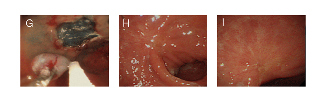 G. 절제한 후 절제술에 의해 생긴 궤양이 보인다.
H. I. 2개월 추적 내시경 사진으로 궤양이 반흔으로 치유된 모습.