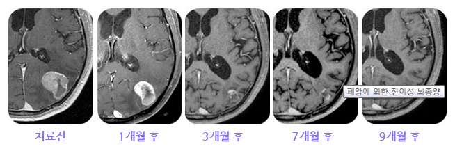 폐암에 의한 다발성 전이성 뇌종양