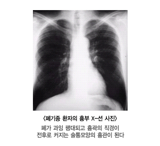폐기종 환자의 흉부X-선 사진