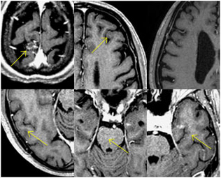 폐암에 의한 다발성 전이성 뇌종양3
