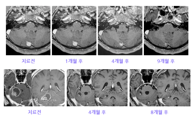 위암에 의한 전이성 뇌종양