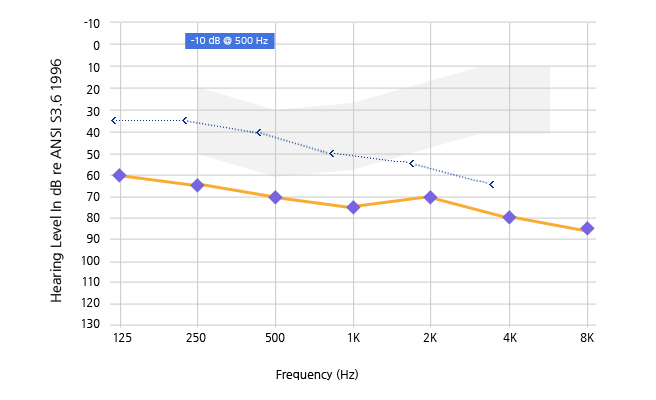 혼합성 난청 (Mixed hearing loss)