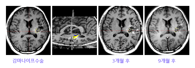 뇌혈관질환 - 해면상혈관종  MRI이미지