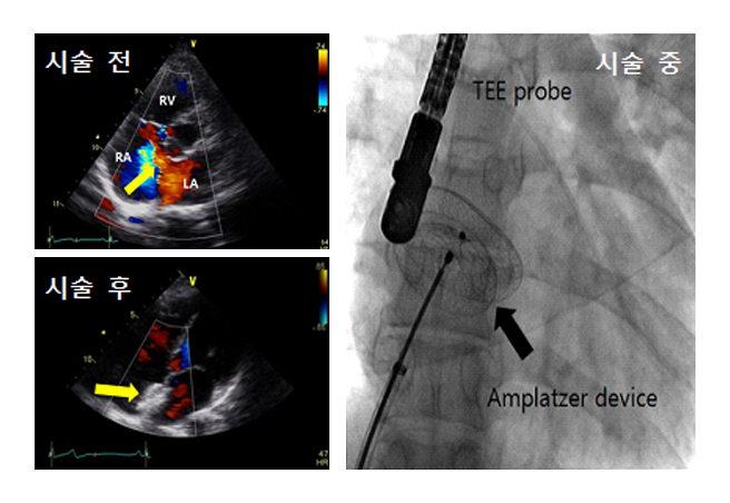심장중격 결손증의 중재시술. 중재시술 전 심장초음파에서 심방중격 결손을 통한 혈류가 관찰되지만 중재시술로amplatzer device를 삽입한 후에는 혈류가 관찰되지 않고 있다.