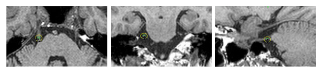 삼차신경(trigeminal nerve)에 방사선이 정확하게 조사된 치료계획영상