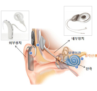 인공와우 수술