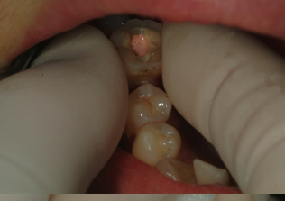 치료가 끝난 치아를 재자리에 넣고 4~6주간 기다립니다.