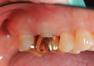 수술후 약 1년 경과 모습. 원래의 치아와 똑같이 기능하고 사용하고 있으며 다른 자연 치아와 거의 차이점을 느낄
			수 없습니다.