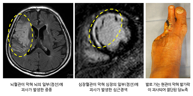 뇌혈관이 막혀 뇌의 일부(점선)에 괴사가 발생한 중풍, 심장혈관이 막혀 심장의 일부(점선)에 괴사가 발생한 심근경색 발로가는 혈관이 막혀 발가락이 괴사되어 절단된 당뇨족