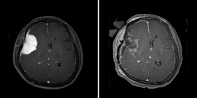 수술 후 병리검사 결과 뇌수막종으로 진단되었던 환자의 수술 전, 후 MRI 사진