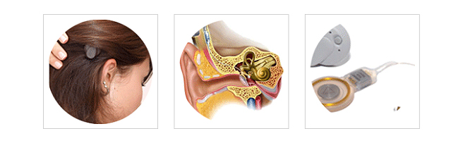 중이 이식형 보청기(MEI)
