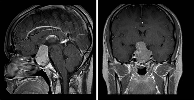 뇌하수체 선종의 MRI 소견: 뇌 정중앙부에 하얗게 조영 증강되는 종양이 위치하고 있다.