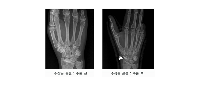 주상골 골절 : 수술전, 주상골  골절 : 수술 후