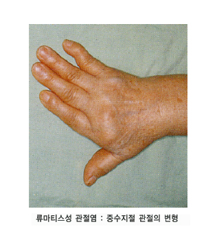 손가락 류머티즘 관절염의 특징과 대처법 천개의 그리움