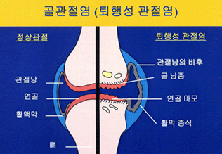 골관절염(퇴행성관절염)