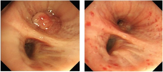 광역학 치료(Photodynamic therapy : PDT) 센터