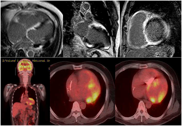 심장 유육종증 	(sarcoidosis)의 심장 MR 영상 및 PET 영상. 심장 MRI와 PET을 이용하여 제한성심근증을 유발한 유육종증을 	진단할 수 있었다.