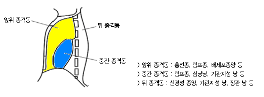 종격동 종양