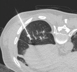 고주파 열치료(Radio - freqeuncy ablation : RFA)