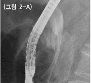 자가팽창성금속관을 담도협착부위에삽입한 직후에 찍은 사진, 협착으로 인해 좁아져 있는
					금속관은 서서히 펴집니다.