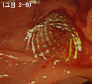 상기 환자에 금속관을 삽입한 후 내시경으로 바라보고 있는 사진