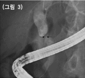 담낭절제술 후 2년 반 경과후 담도 협착이 발생한 경우, 협착부위에 조영제는 차지
					않고 그 상부 담도가 확장되어 있음, 스텐트 삽입을 위해 협착부위를 통과해서 유도철사를 넣어놓은 사진