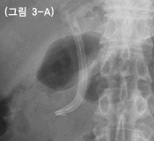 두개의 플라스틱관이 협착 부위를 통과해서 위치하고 있는 사진