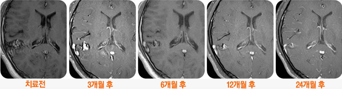 우측 측두엽과 후두엽사이에서 발견된 뇌동정맥기형 치료사례