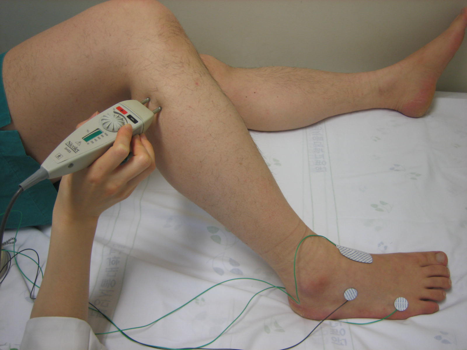 신경전도검사(Nerve Conduction Study: NCS)