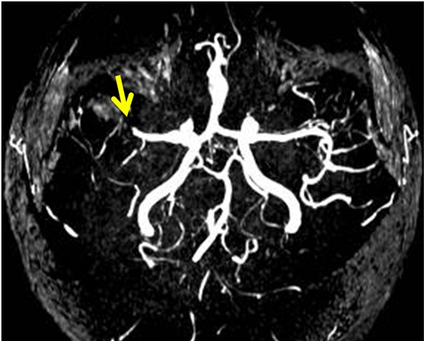 MR 혈관 조영술 (MR angiography) 소견. 우측 중대뇌동맥의 폐색이 관찰됨.
			