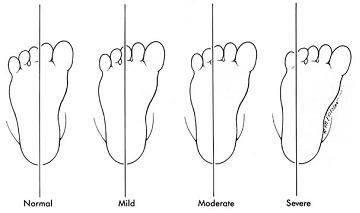 그림1. 정상에서는 발뒤꿈치를 이등분하는 선이 둘째발가락과 셋째 발가락 사이를 지나지만 내전 중족골증에서는 발 앞부분이 안으로 휘므로 이 선이 바깥을 지나며 바깥쪽으로 많이 나갈수록 심한 정도가 증가하게 됩니다.