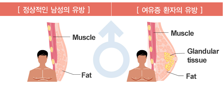 [정상적인 남성의 유방] Muscle, Fat. [여유증 환자의 유방] Muscle, Glandular tissue, Fat.