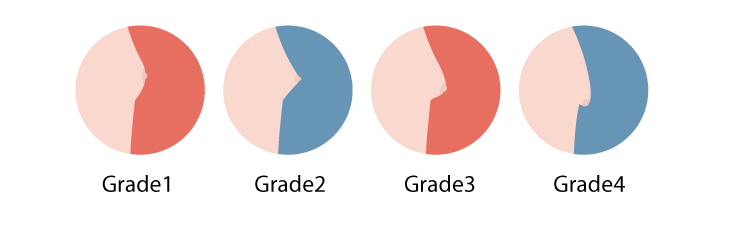Grade1, Grade2, Grade3, Grade4