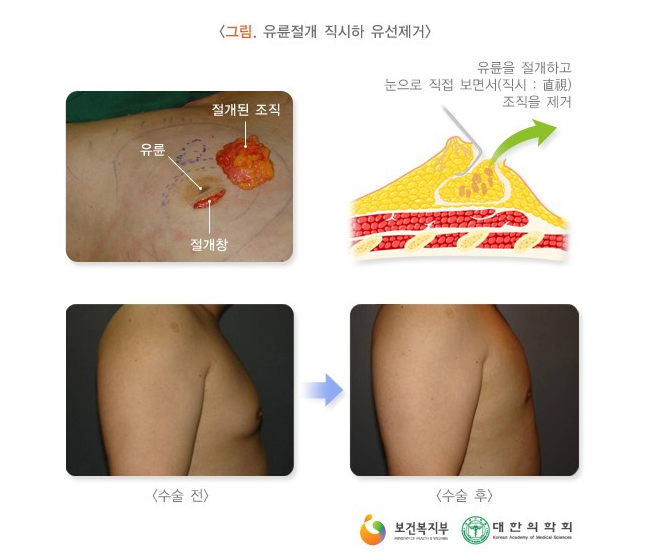[그림. 유륜절개 직시하 유선제거] 유륜을 절개하고 눈으로 직접 보면서(직시 : 直視) 조직을 제거. [수술 전] [수술 후]. 보건복지부. 대한의학회