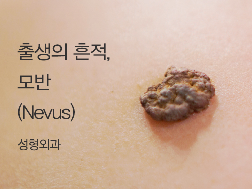 출생의 흔적, 모반 (Nevus)