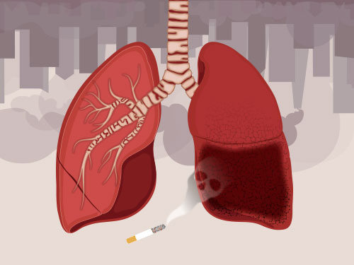 비흡연자도 피해갈 수 없는 암 사망률 1위, 폐암