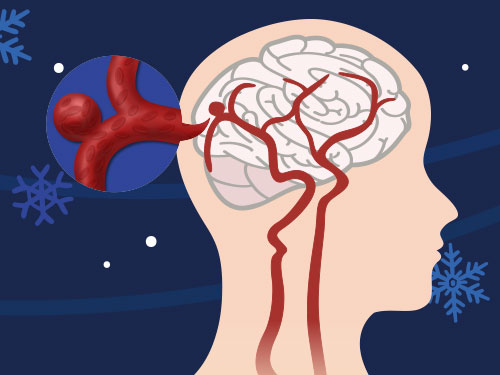 내 머리 속 위험한 시한폭탄, 뇌동맥류