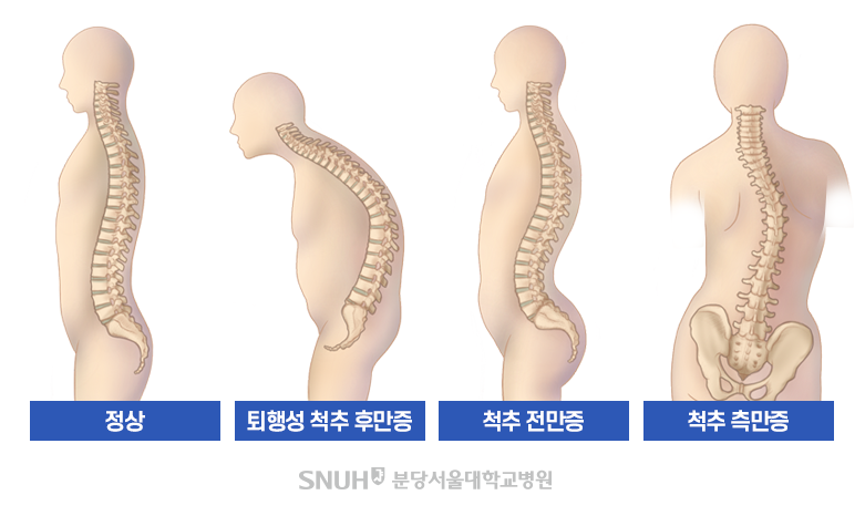 척추 후만증의 생활습관 개선 효과