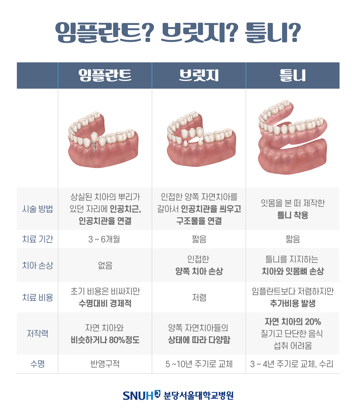 임플란트 시술기간 핵심 총정리