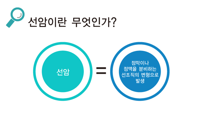 선암이란 점막이나 점액을 분비하는 선조직의 변형으로 발생한다