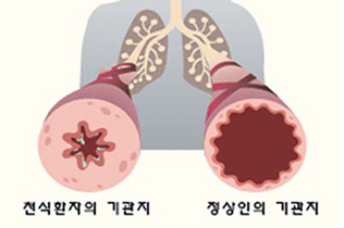 소아청소년기관지천식 최봉석 소아청소년과 교수