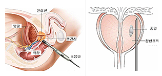 전립선암 진단 - 생검