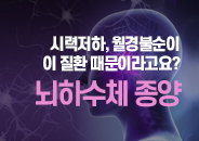 2022.07 시력저하, 월경불순이 이 질환 때문이라고요? 뇌하수체 종양